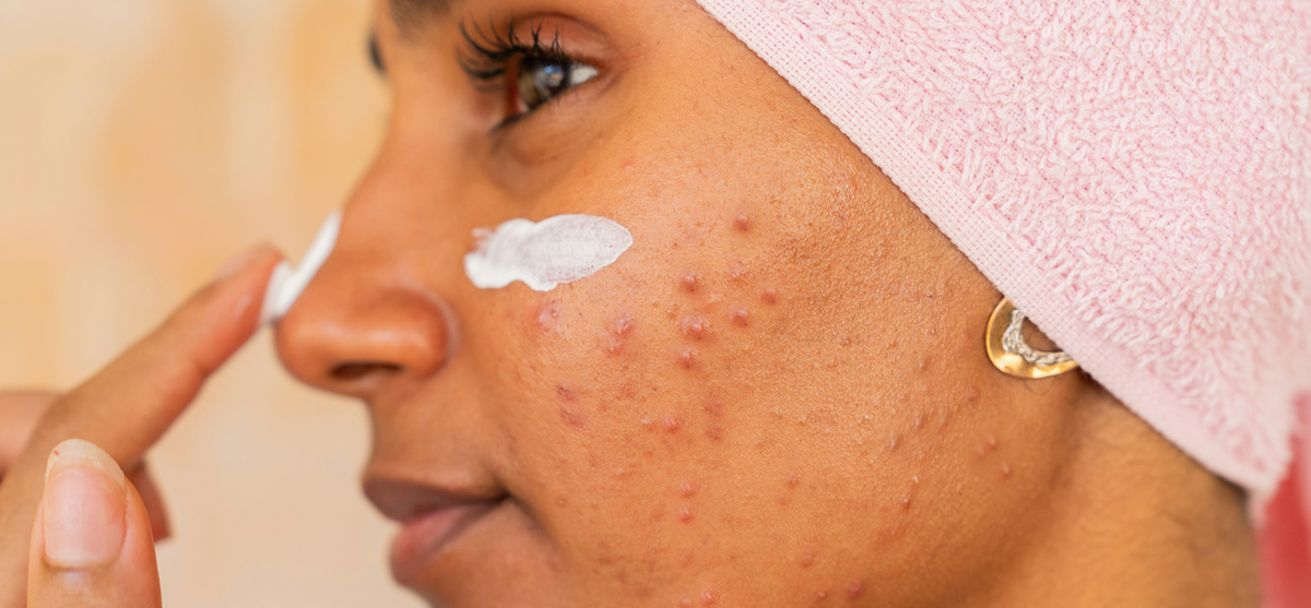 5 Breakthrough Ways to Treat Acne With Liquid Collagen