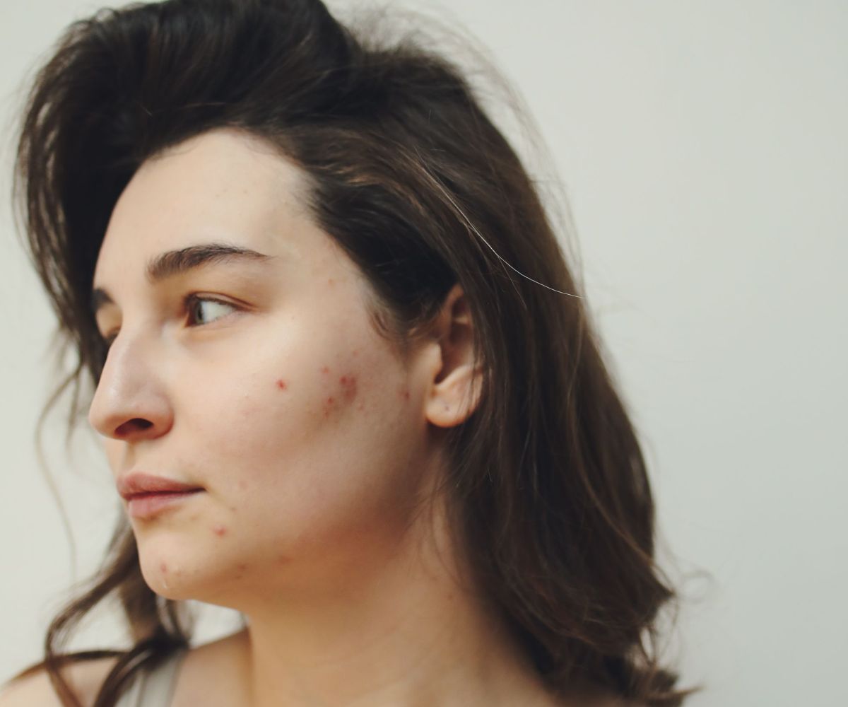 How To Get Rid Of Acne