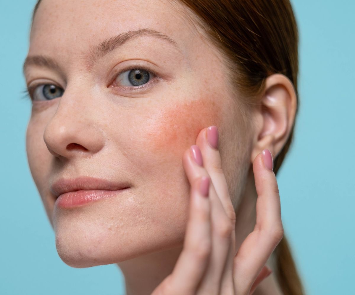 How To Manage Rosacea Effectively